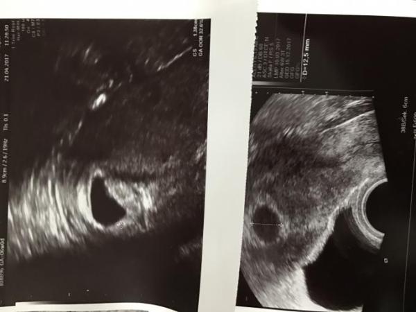 Bild zu SSW 6+3 - Forum für Dezember - Mamis