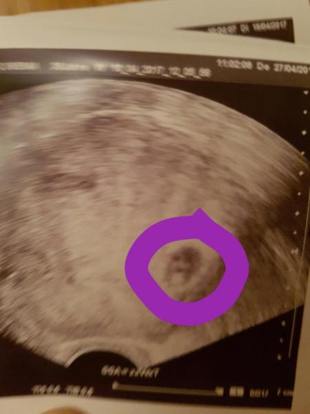 Bild zu Ultraschallbildchen - Forum für Dezember - Mamis