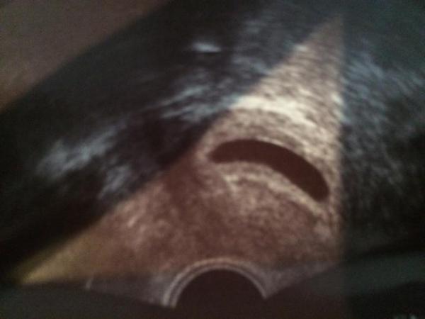 Bild zu Ssw 6+2 - Forum für Dezember - Mamis