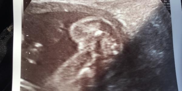 Bild zu Organ Screening + Outing - Forum für Dezember - Mamis