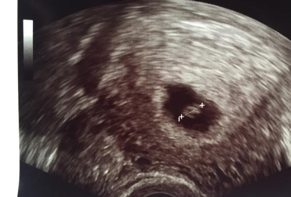 Bild zu Erster Ultraschall und neuer ET + Gefühle einer neuen Dimension < 3 - Forum für Dezember - Mamis