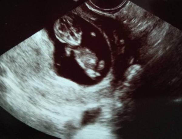 Bild zu 1. Vorsorgeuntersuchung und Foto - Forum für Dezember - Mamis
