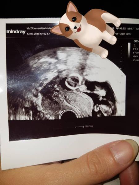 Bild zu Vorderwandplazenta? - Forum für Dezember - Mamis