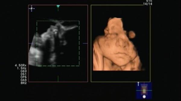 Bild zu 3. Screening und 3D-Ultraschall - Forum für Dezember - Mamis