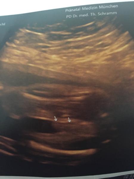 Bild zu Ultraschall Geschlecht - Forum für Dezember - Mamis