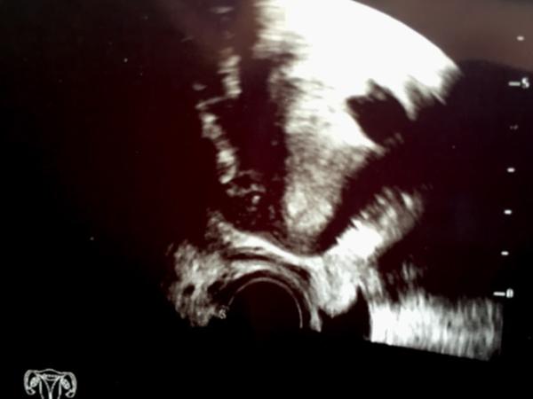 Bild zu US schwer wegen gestreckter Gebärmutter und KS... - Forum für Dezember - Mamis