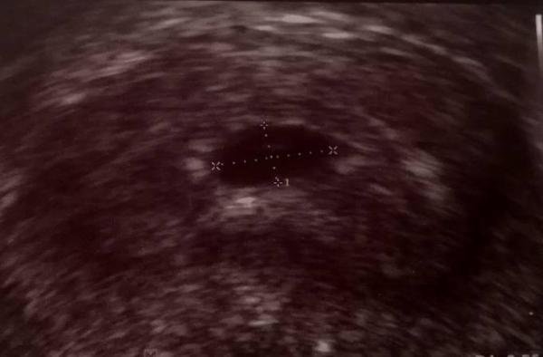 Bild zu 5-6 SSW / 1. Ultraschall - Forum für Dezember - Mamis