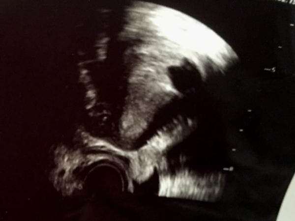 Bild zu Embryo sehr weit oben - Forum für Dezember - Mamis