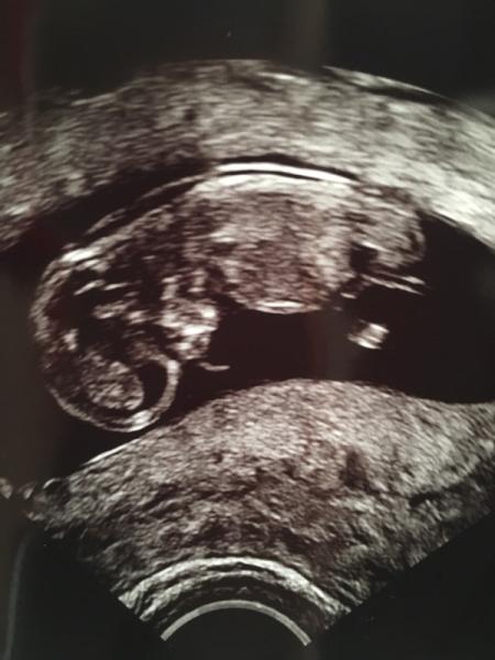 Bild zu Heute erster großer Ultraschall - Forum für Dezember - Mamis