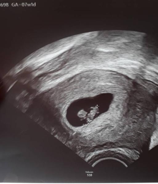 Bild zu Ultraschall 8.SSW - Forum für Dezember - Mamis