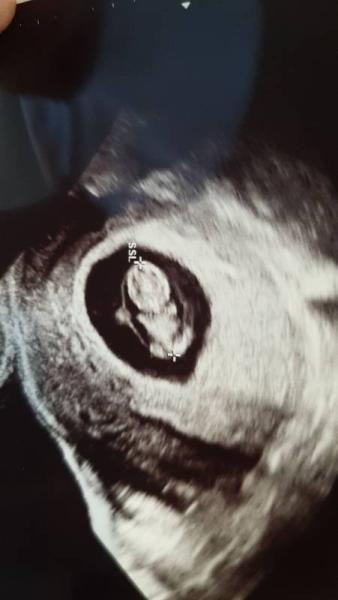 Bild zu Ultraschall 9+1 - Forum für Dezember - Mamis