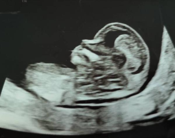 Bild zu Erst Trimester Screening - Forum für Dezember - Mamis
