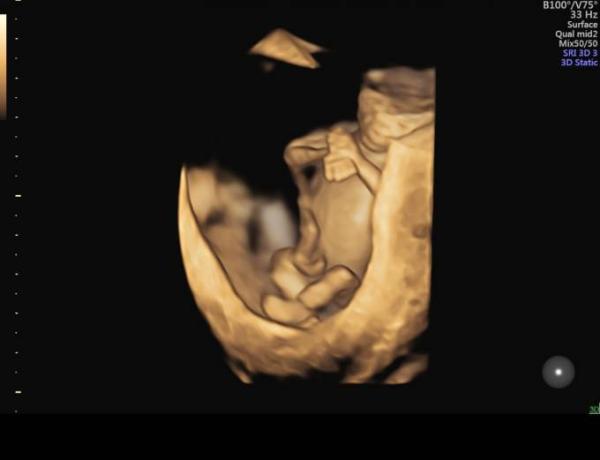 Bild zu Nackenfaltenmessung 💗 2 ter ultraschal - Forum für Dezember - Mamis