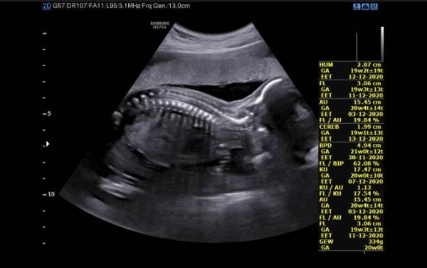 Bild zu 2 großer Ultraschall - Forum für Dezember - Mamis