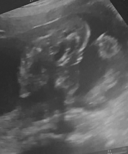 Bild zu 2. Organscreening in der 21 Ssw - Forum für Dezember - Mamis