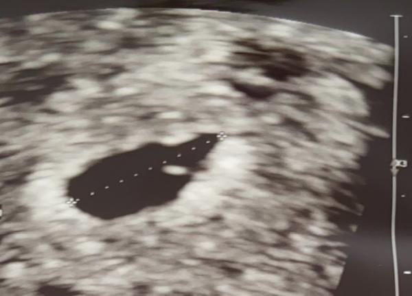 Bild zu Nur die Fruchthöhle auf dem Ultraschall - Forum für Dezember - Mamis