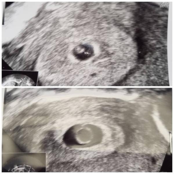 Bild zu 7+5 Fruchthöhle plötzlich leer ?! - Forum für Dezember - Mamis