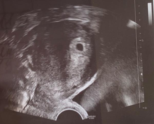 Bild zu 1. Ultraschall … keine ahnung welche SSW - Forum für Dezember - Mamis