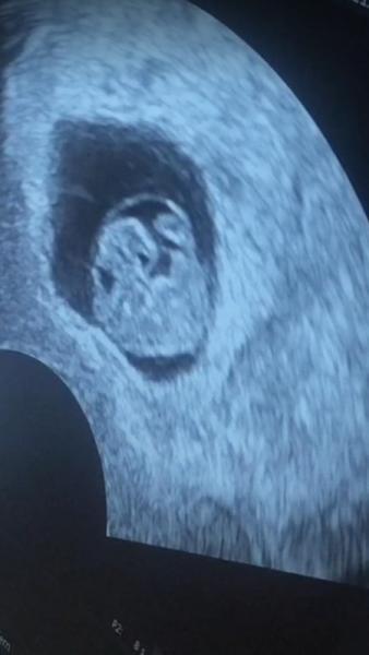 Bild zu Ultraschall - Forum für Dezember - Mamis