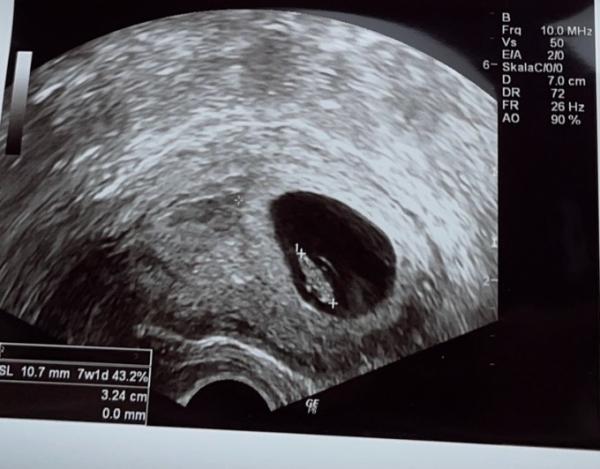 Bild zu Ultraschallbild - Forum für Dezember - Mamis