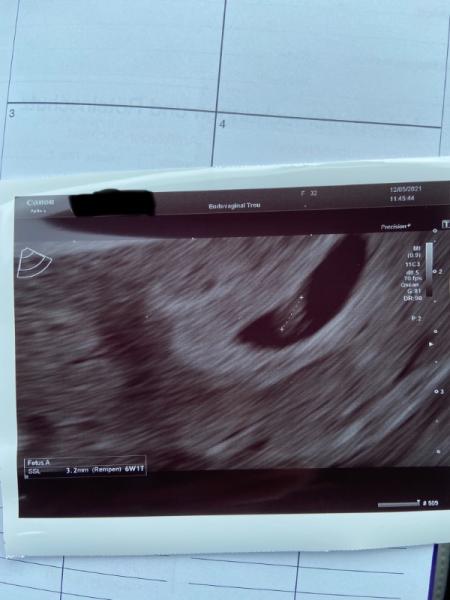 Bild zu Embryo schwer zu finden - Forum für Dezember - Mamis