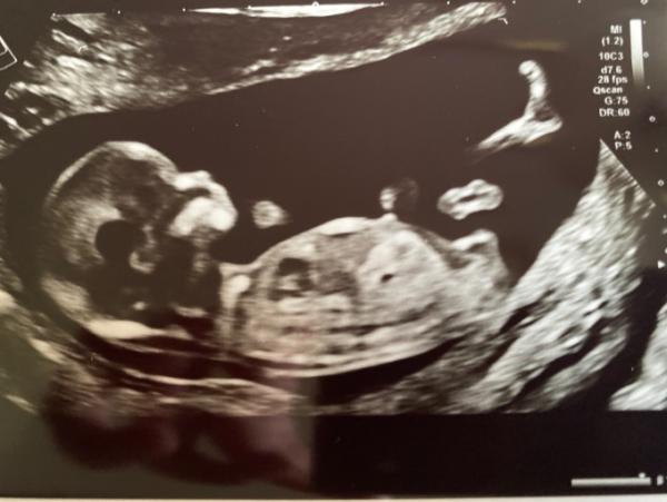 Bild zu Ersttrimester Screening - Forum für Dezember - Mamis