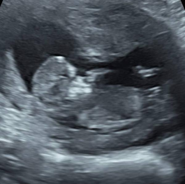 Bild zu ETS + Praenatest - Forum für Dezember - Mamis