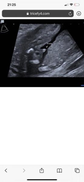 Bild zu Auf was für ein Geschlecht würdet ihr tippen? - Forum für Dezember - Mamis