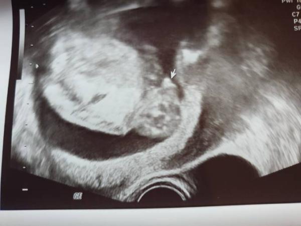 Bild zu Geschlecht Outing 17+6 ssw - Forum für Dezember - Mamis