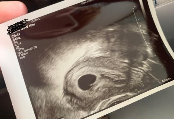 Bild zu Ultraschall 5+4 - Forum für Dezember - Mamis