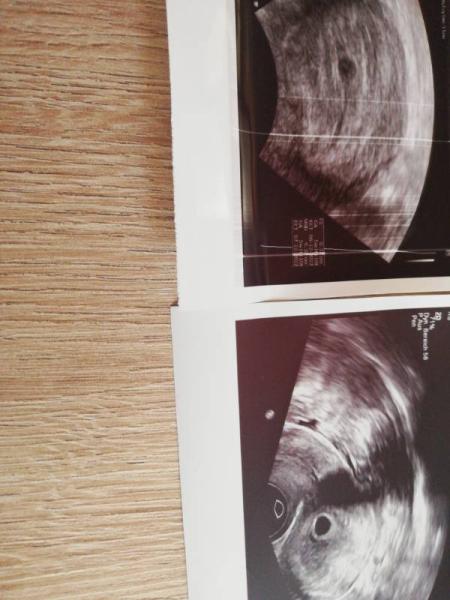 Bild zu Ultraschallbild 6+2 oder doch 5+6? - Forum für Dezember - Mamis