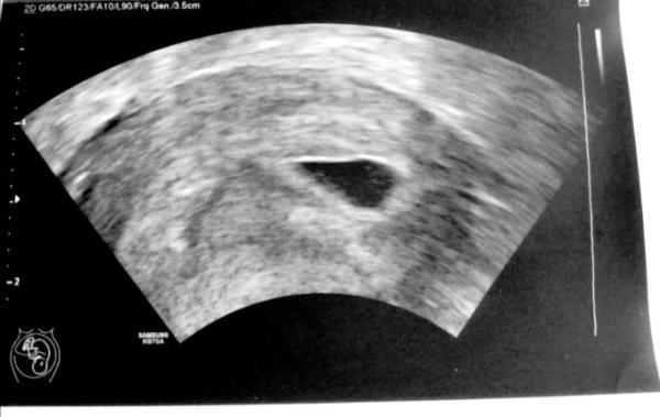 Bild zu Letztes Ultraschallbild - Forum für Dezember - Mamis