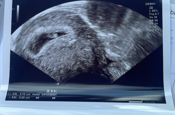 Bild zu Ultraschall 7+0 - Forum für Dezember - Mamis