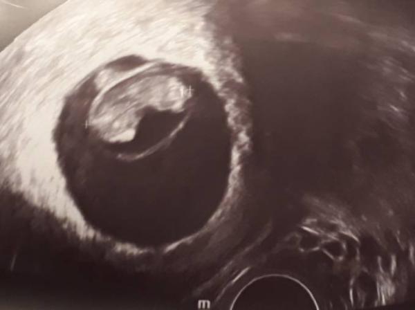 Bild zu Fehlalarm bei Blutungen und eine Bohne - Forum für Dezember - Mamis