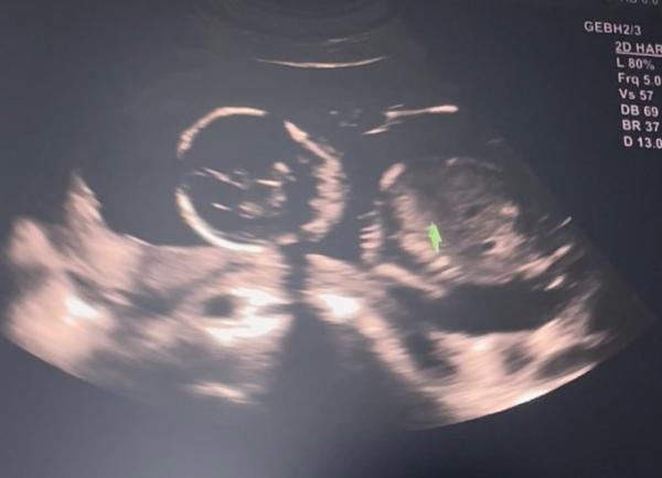 Bild zu US bei 18+0 - Forum für Dezember - Mamis