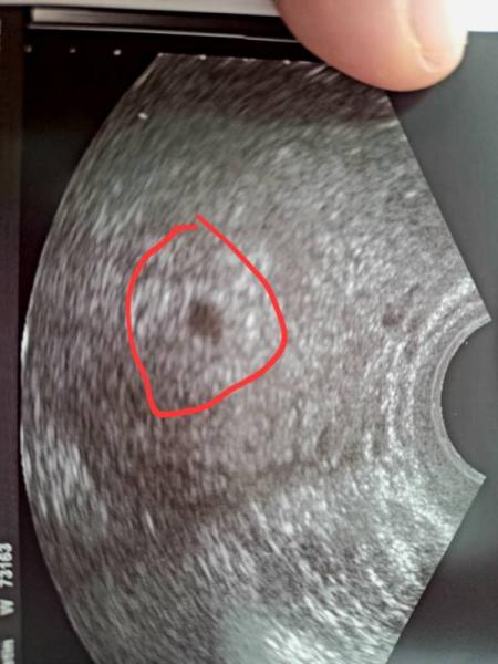 Bild zu Fruchthöhle sichtbar bei SSW 5+3 - Forum für Dezember - Mamis