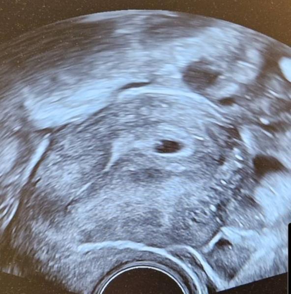 Bild zu Ultraschallbild ssw5? - Forum für Dezember - Mamis