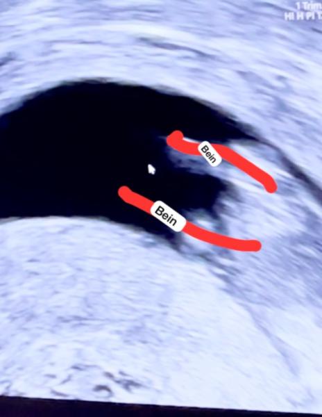 Bild zu Junge oder Mädchen? 🩵🩷 was meint ihr? - Forum für Dezember - Mamis