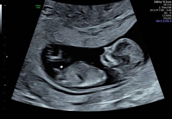 Bild zu 13ssw geschlecht - Forum für Dezember - Mamis