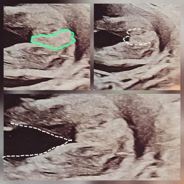 Bild zu Outing zu Baby Nr.3. 50 / 50 Junge Mädel - Forum für Dezember - Mamis