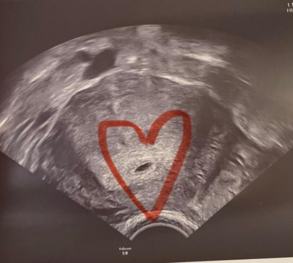 Bild zu 1. Ultraschall 🥹 - Forum für Dezember - Mamis
