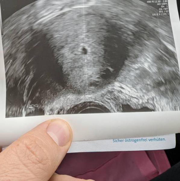 Bild zu Erstes Ultraschallbild - Forum für Dezember - Mamis