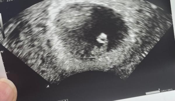 Bild zu Meilenstein Herzschlag 🥹 - Forum für Dezember - Mamis