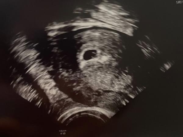 Bild zu Ultraschall 6+1 - Forum für Dezember - Mamis