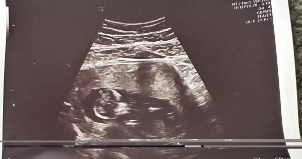 Bild zu Junge oder Mädchen? Nub-Theorie und Skull-Theorie? Was sagt ihr? :) - Forum für Dezember - Mamis