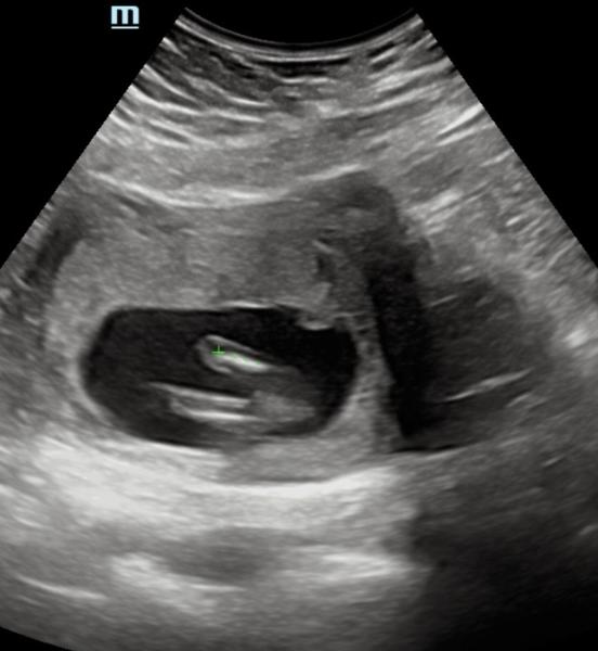 Bild zu Was denkt ihr welches Geschlecht es sein wird ? - Forum für Dezember - Mamis