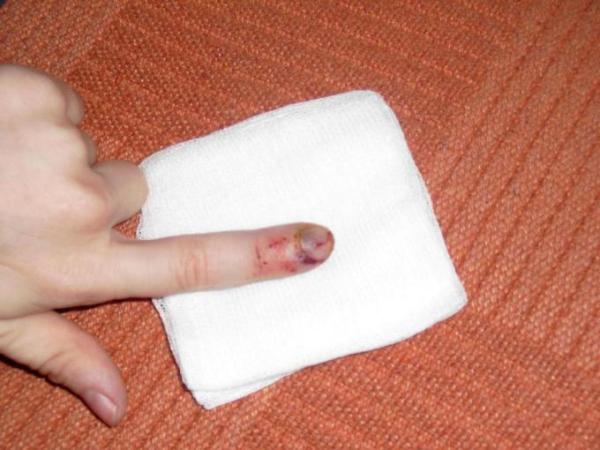 Bild zu So sieht ein "Kegelfinger" nach 2 Tagen aus. - Baby Forum - Allgemeine Themen