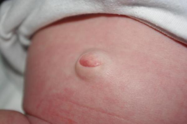 Bild zu Ist das ein Nabelbruch???????? - Baby Forum - Allgemeine Themen
