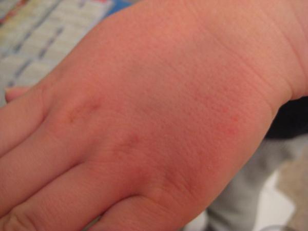 Bild zu Rauhe, gerötete Haut mit Pickelchen - Baby Forum - Allgemeine Themen