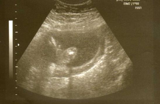 Bild zu Ich war heute morgen schon beim Gyn.. - Baby Forum - Allgemeine Themen